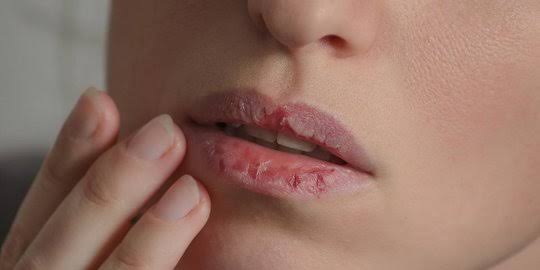 Cara Atasi Bibir Kering dan Mengelupas