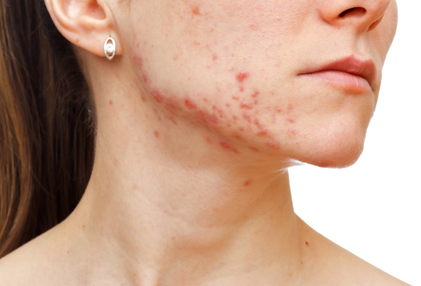 Perawatan Untuk Menghadapi Adult Acne