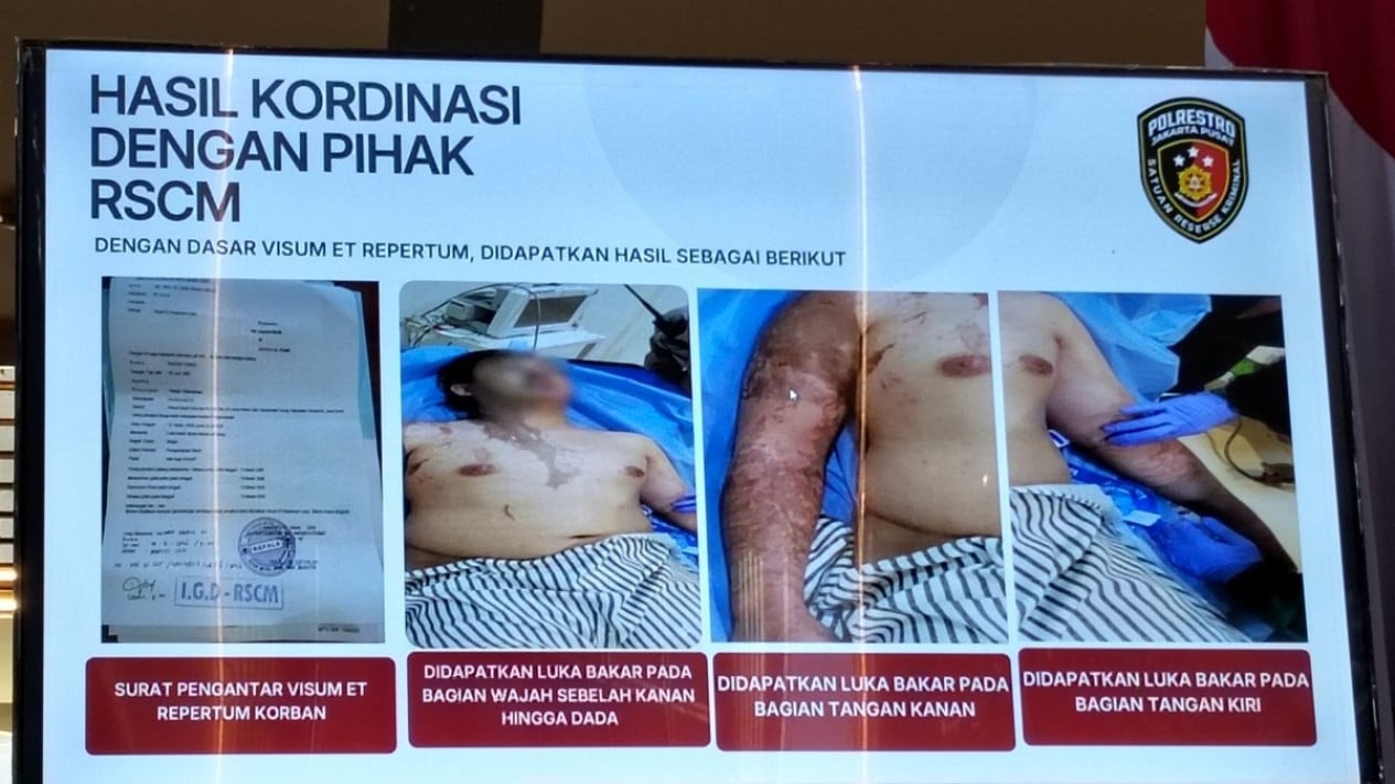 RSCM Operasi dan Pulihkan Mata Andrie Yunus Akibat Air Keras
